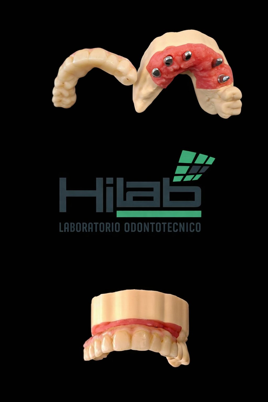 Overdenture su impianti